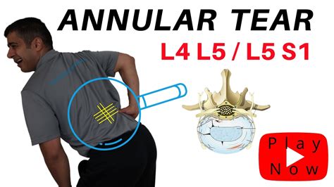 bulging disc annular tear treatment